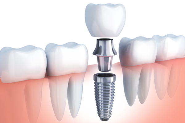 Single tooth implants
