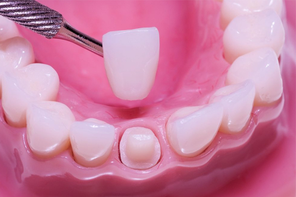 ceramic crowns