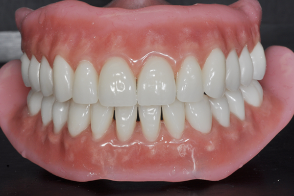 denture